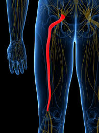 Sciatica Physio Rugby